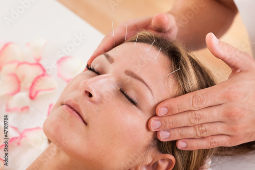 Woman undergoing acupuncture treatment photo