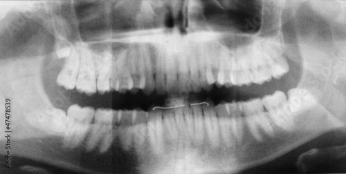 X-ray of human jaw