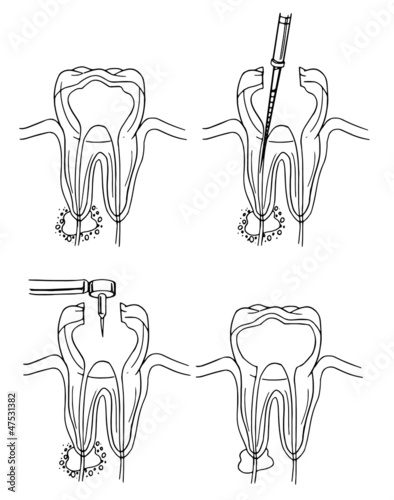 Root canal procedure