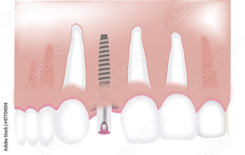 dental prosthesis