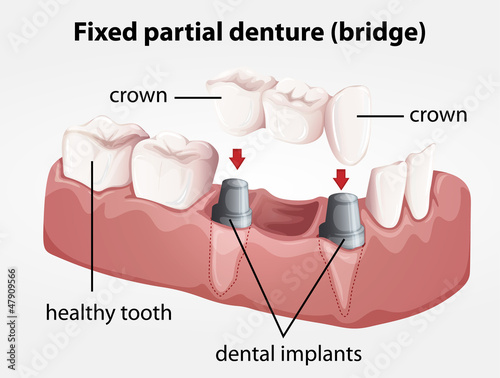 Fixed partial denture bridge #47909566