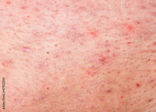 Wallpaper Mural Human skin with acne Torontodigital.ca