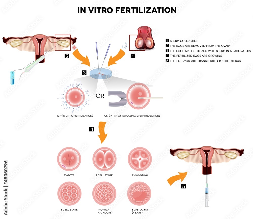 In vitro fertilization. Detailed illustrations In vitro fertilization. Detailed illustrations