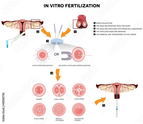 In vitro fertilization. Detailed illustrations