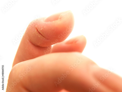 Closeup of wounded finger, isolated towards white background