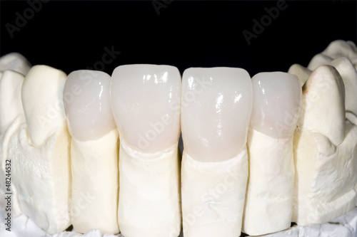 Ceramic crown