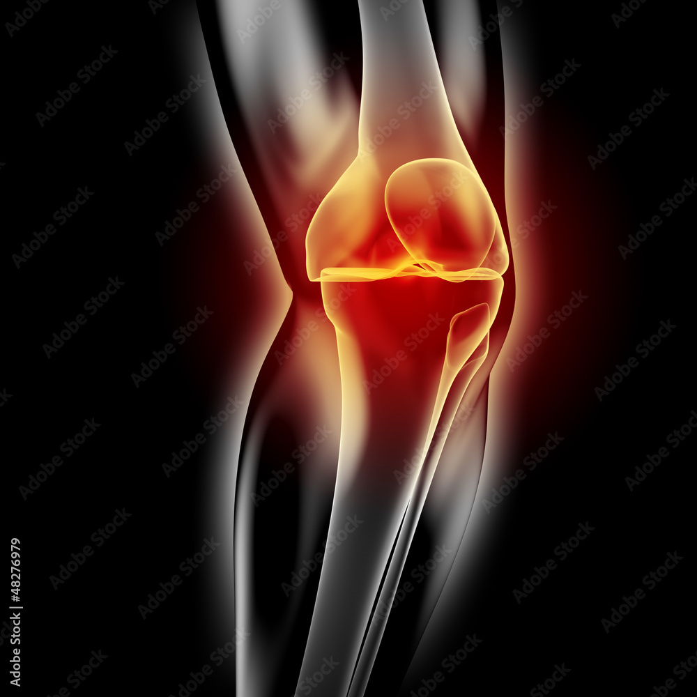 Knie-Schmerzen - Röntgenbild - 3D Grafik Stock Illustration | Adobe Stock