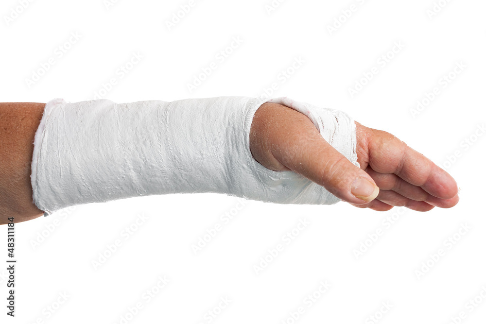 Broken arm with a plaster cast isolated on white Stock Photo | Adobe Stock