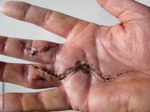 hand scar after dupuytren's disease surgery photo