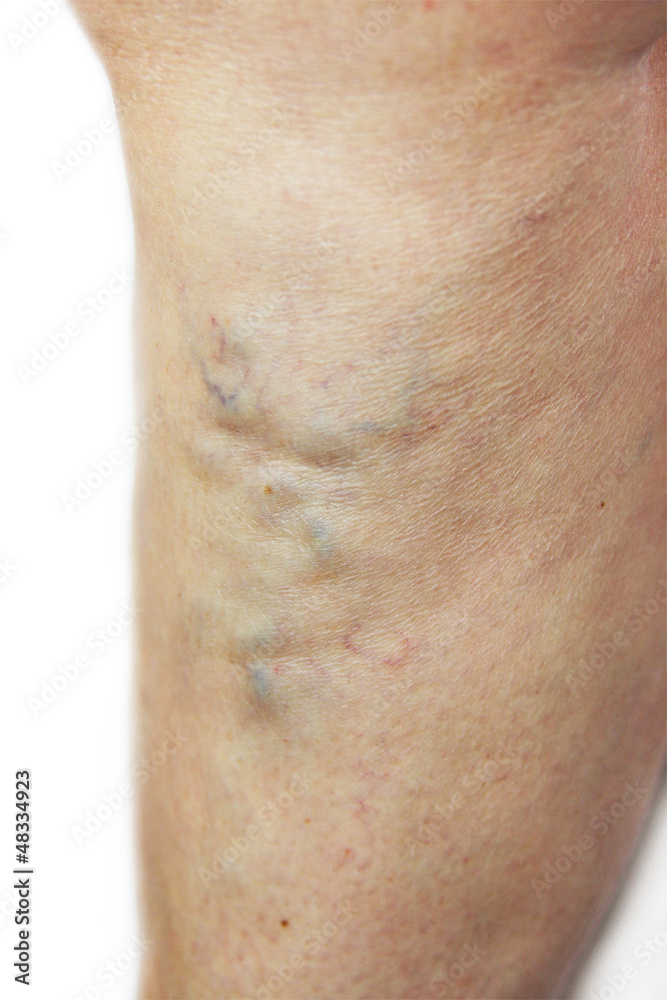 Fototapeta premium żylaki