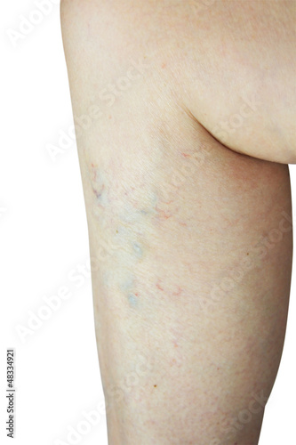 varicose veins