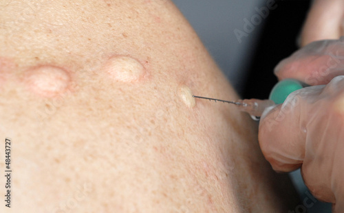 Pateintin wird mit Procain im Nackenbereich gequaddelt photo