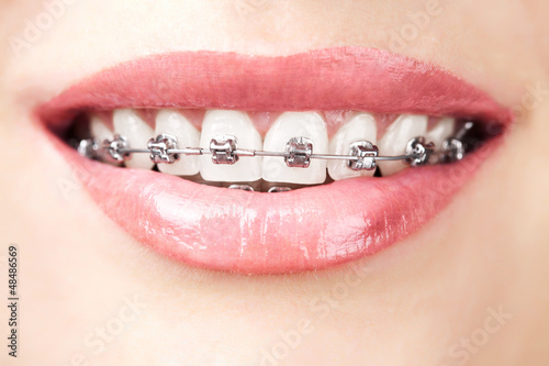 teeth with braces #48486569