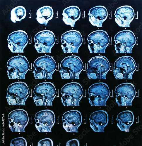 IRM du cerveau