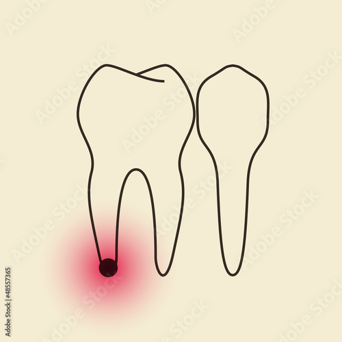 Toothache - Pulpitis