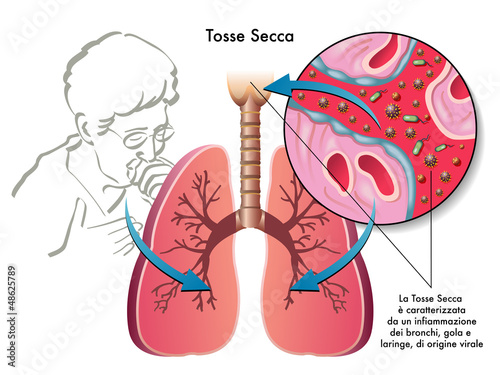 tosse secca