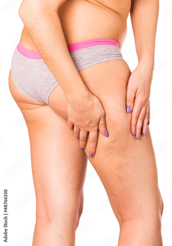 Skin with a cellulite