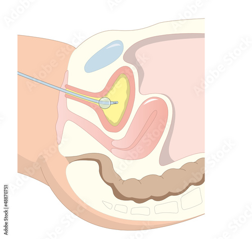 Blasenkatheter photo