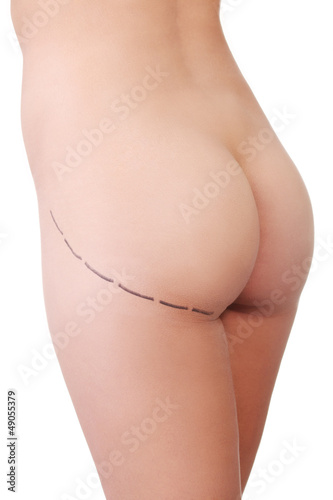 Woman's buttock prepared to plastic surgery