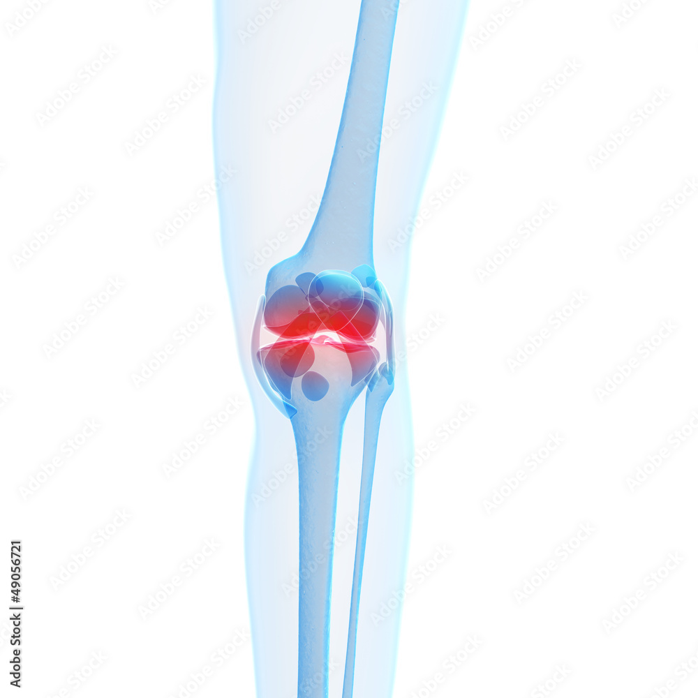 3d rendered illustration of a painful knee 3d rendered illustration of a painful knee