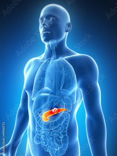 3d rendered illustration of the male pancreas - cancer