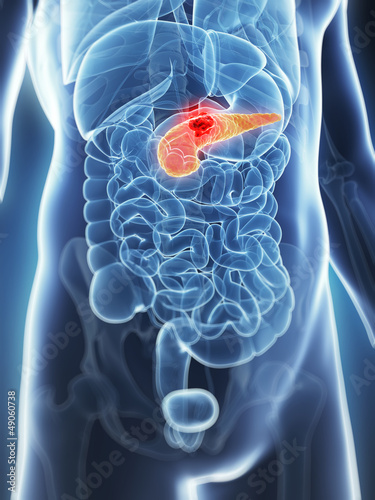 3d rendered illustration of the male pancreas - cancer photo