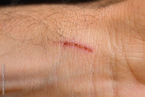 Φωτογραφία scab over internal side of wrist