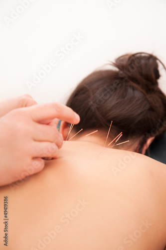 Acupuncture in the neck