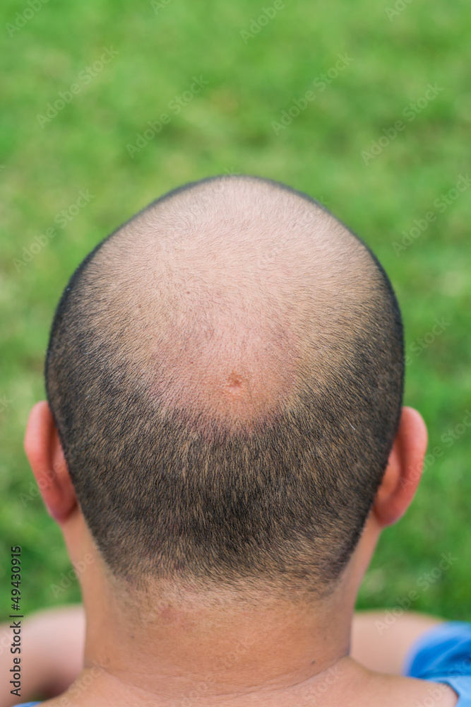 Fototapeta premium A crater in the middle of the head