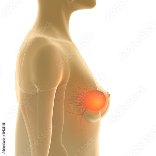 Breast Cancer - 3D Render
