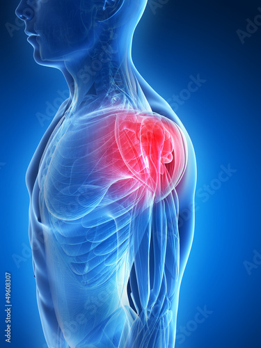3d rendered illustration - painful shoulder muscles