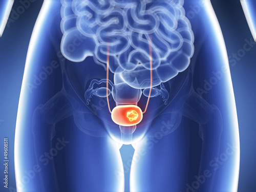 3d rendered illustration - bladder cancer photo