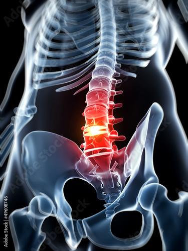 Cuadro en lienzo 3d rendered illustration - herniated disk