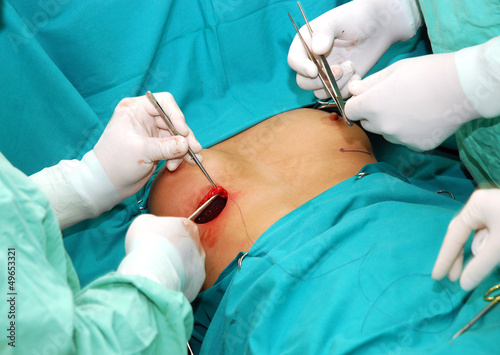 Obraz na płótnie Breast augmentation surgery