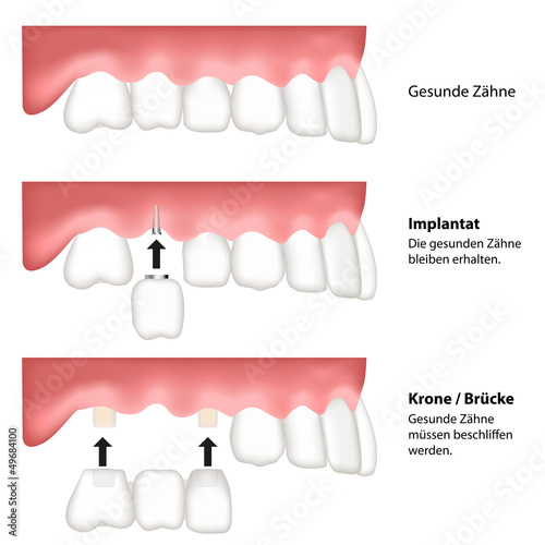 zahn ersatz illustration - vergleich brücke implantat