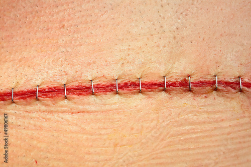 Modern surgical suture.