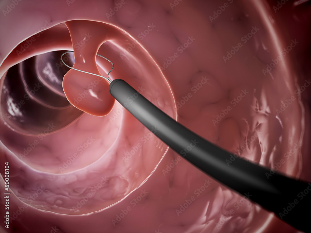 Ταπετσαρία 3d rendered illustration of a polyp removal