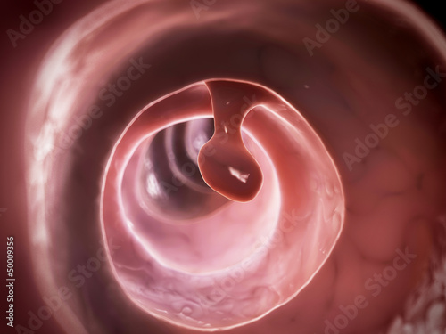 Canvastavla 3d rendered illustration of a colon polyp