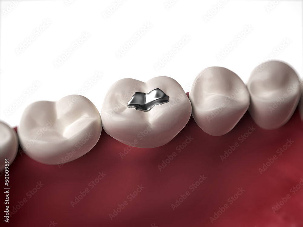 Ταπετσαρία 3d rendered illustration of an amalgam filling