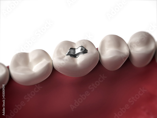 3d rendered illustration of an amalgam filling