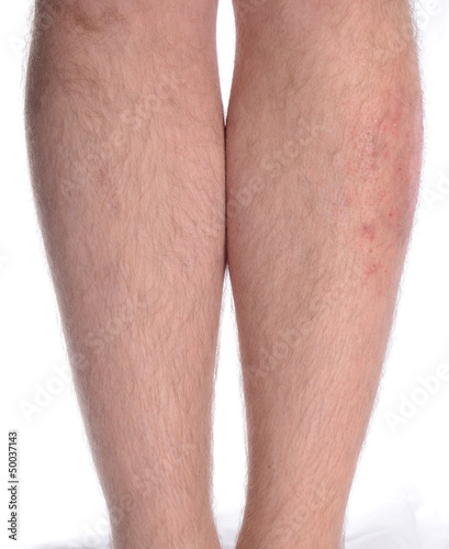 Skin Disease on the Leg