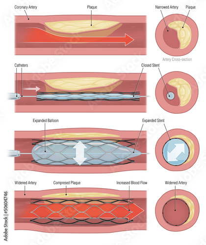 Medical illustration showing coronary angioplasty with balloon expansion and stent placement to open a narrowed artery and restore normal blood flow.