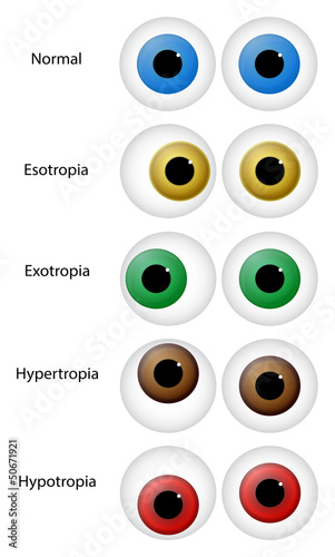 Eye Disorders