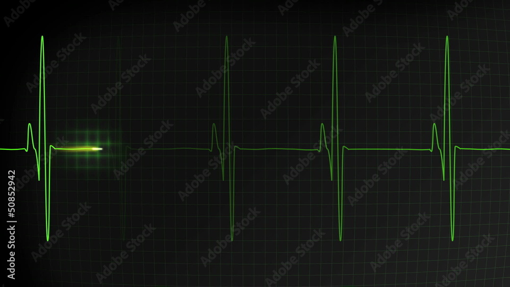 Fast heartbeat pulse monitored on a hospital EKG