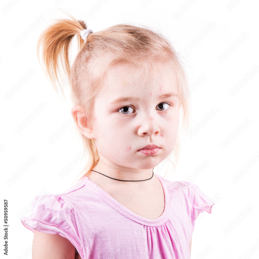 Sick little girl with chickenpox