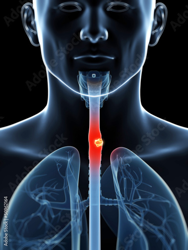 Fotografie 3d rendered illustration of esophagus cancer