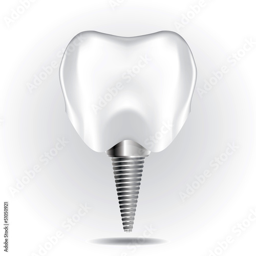 Tooth Implant Set 1