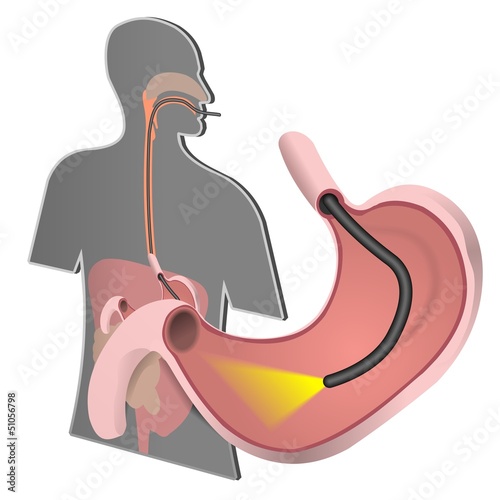 Endoscope