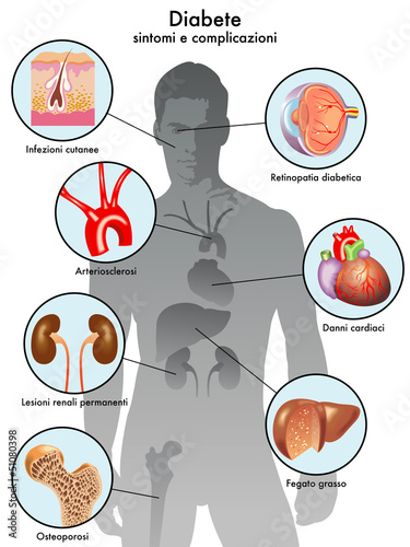 diabete (sintomi e complicazioni)