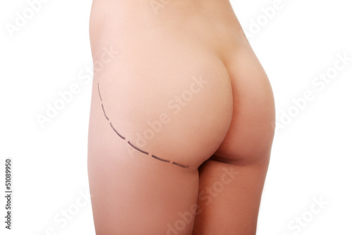Woman's buttock prepared to plastic surgery photo